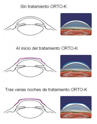 Efecto del tratamiento Orto-K Efecto del tratamiento Orto-K